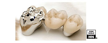 Dental Ceramic Gold Casting - Auritex XP