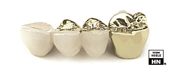 Dental Ceramic Gold Casting - Summit